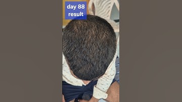 Fast hair growth #hairgrowth #haircare #minoxidil #hair #minoxidilresult