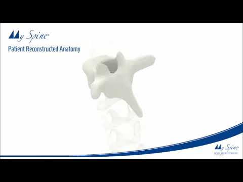 Medacta: VIDEO MySpine Standard Low Profile  Planning & Ingreep