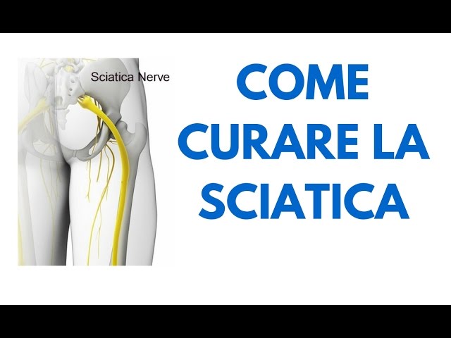 Sciatica: rimedi per il nervo sciatico infiammato + VIDEO ESERCIZI -  Osteoclinic