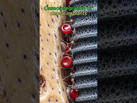 🦷 임플란트가 뼈와 단단하게 하나가 되는 과정 (골유착) #치과상식