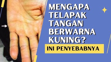 Penyebab Telapak Tangan Kuning #telapaktangan #telapaktangankuning #tangankuning #penyebab