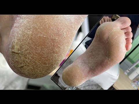 Thin dry skin on the feet / Hardware pedicure