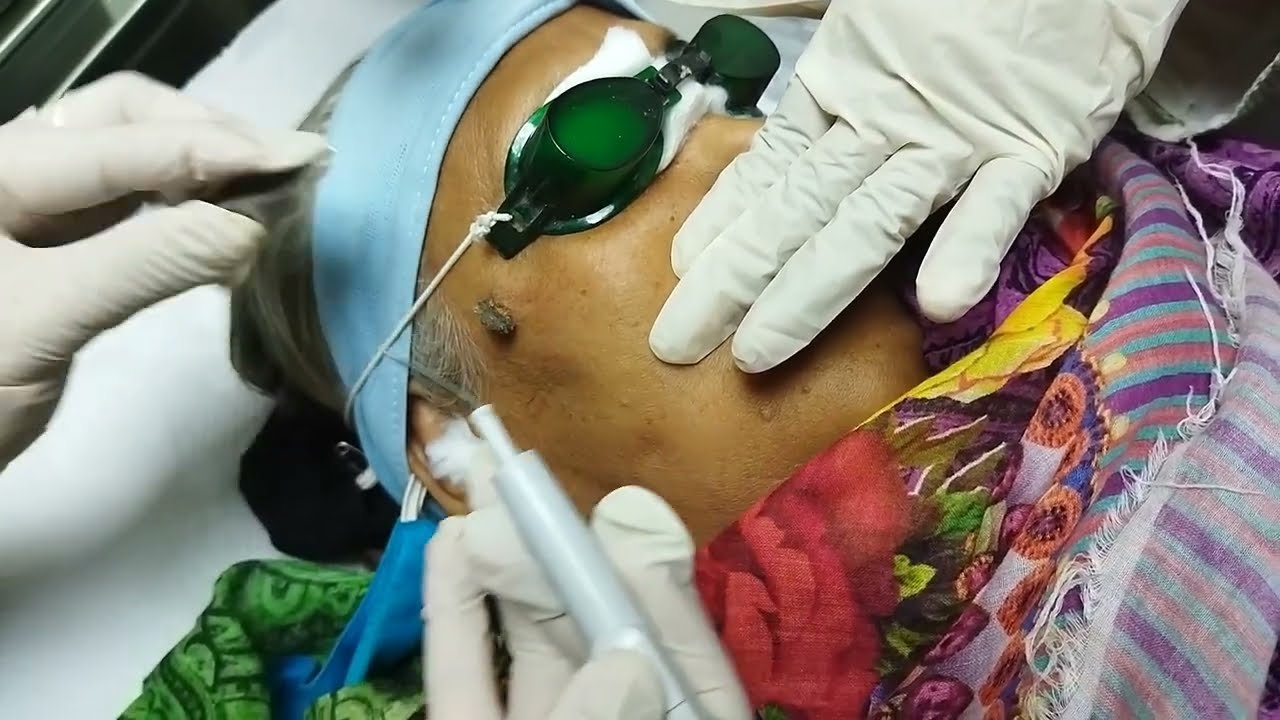 Laser Mole Removal by ELF