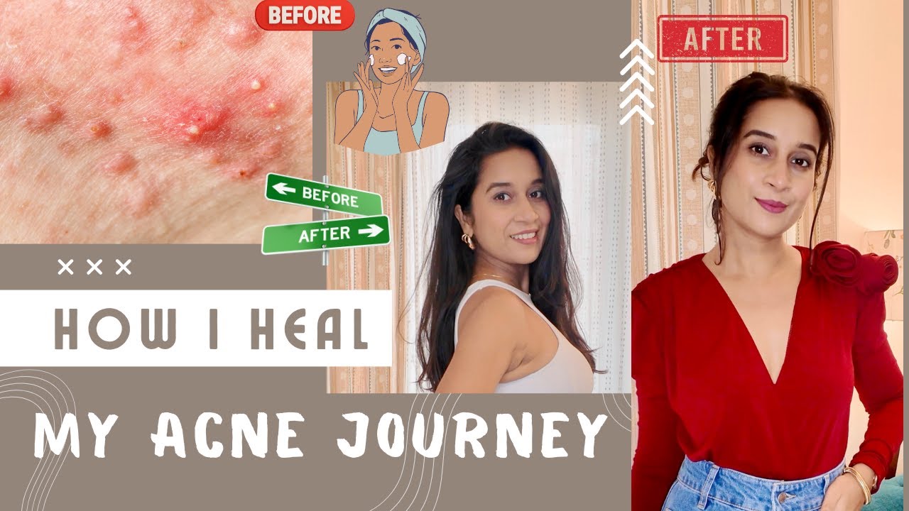 My Acne Journey | How I Cured My Severe Acne | Acne Treatment - YouTube