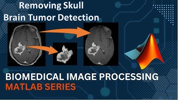 Brain Tumor detection and removing Skull using roipoly || MATLAB || Medical Image Processing