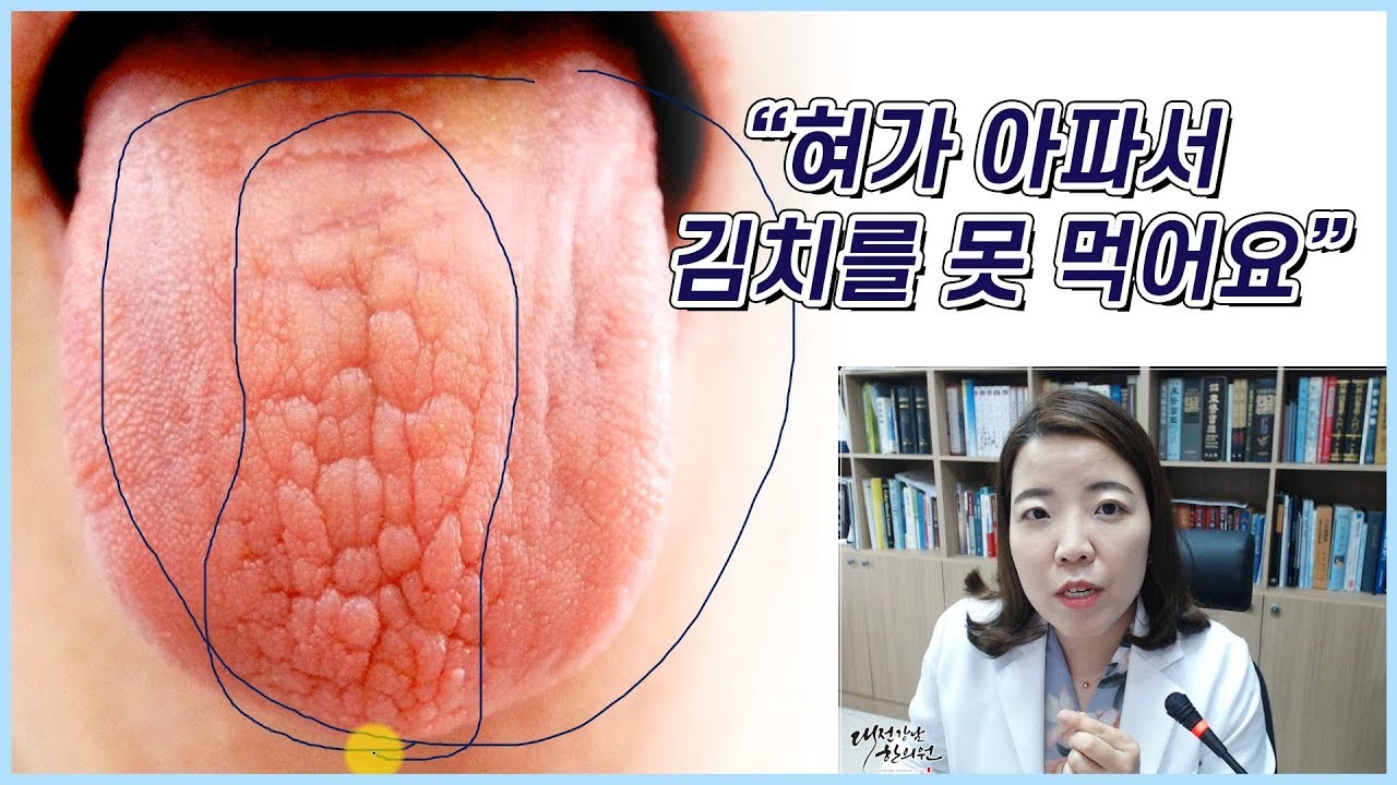 경면설 위축성설염 - 혀에 백태가 벗겨지고 혀가 따갑고 아파요 - YouTube