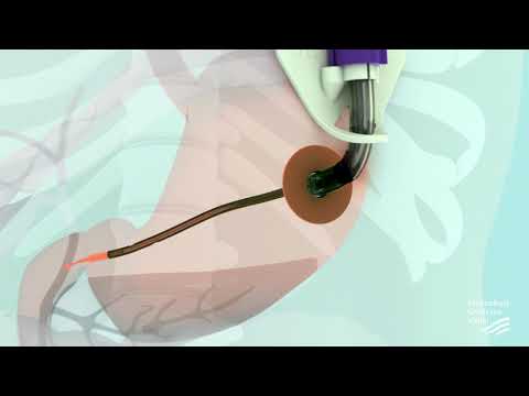 Video: Invoegen Van Voedingssonde (gastrostomie)