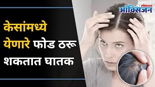 केसांमध्ये येणारे फोड असे करा नाहीसे | Pimples On Scalp | How to Treat Acne On Scalp| Hair Treatment