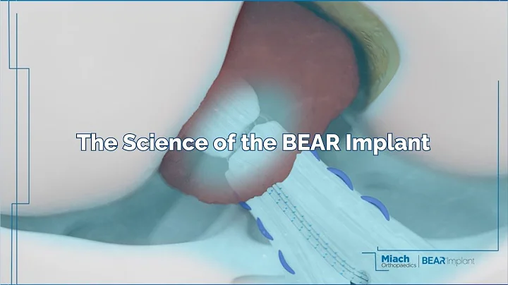 Science of the BEAR Implant | Animation | Miach Orthopaedics
