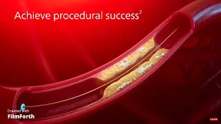 Philips Laser System Laser Atherectomy Catheter Animation 9995832255
