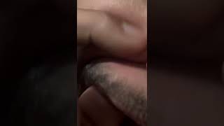 #IngrownHair #SatisfyingRemoval #OddlySatisfying #SkinCare #ExtractionVideo #GroomingRoutine #close