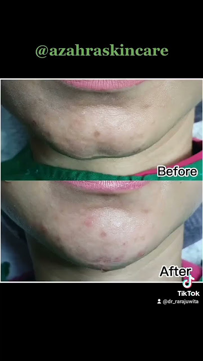 Filler Dagu