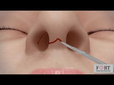 Video: Lina's first plastic surgery - nose correction