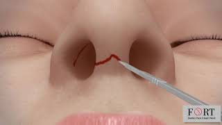 RHINOPLASTY  - Nose Correction - Fort Hospital -nose plastic surgery cost