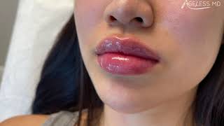 Stunning Lips Filler By Our Pa Cathy Tang - Ageless Md