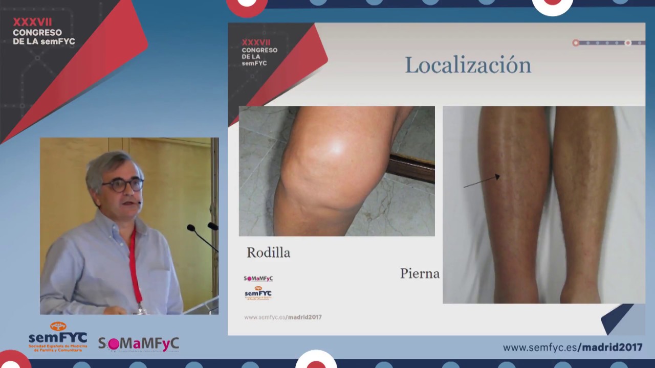 Edema Unilateral Membro Inferior