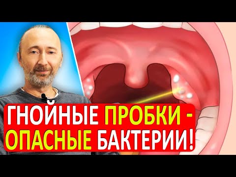 Гнойные пробки в миндалинах: причины и надёжное лечение! Как устранить ЭТИ бактерии раз и навсегда?