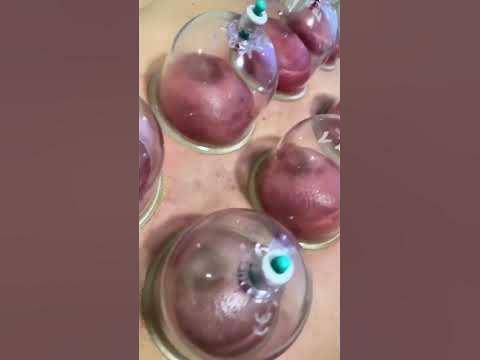Баночний масаж. Масаж банками. Вакуумний масаж. Банки на спину. Масаж ...