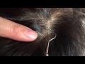 【フケpart1】スッキリ日焼け後頭皮のフケむきstripped dandruff.