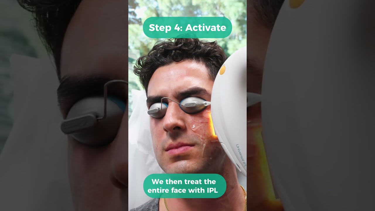 Banner for Photodynamic Therapy - treatment that can help acne, sun damage, AND precancerous spots #PDT