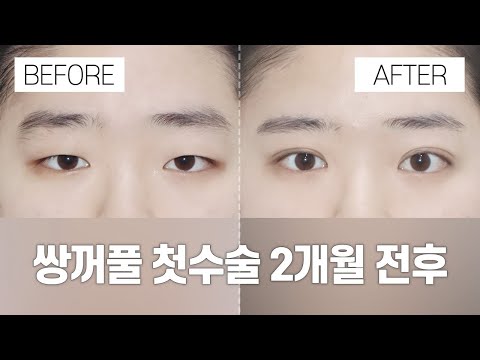 눈 성형 전후 |  절개눈매교정 + 앞트임 2개월 전후