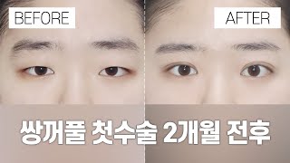 눈 성형 전후 |  절개눈매교정 + 앞트임 2개월 전후