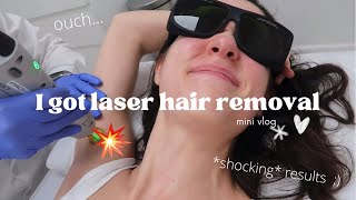 mini vlog ♡ I got laser hair removal