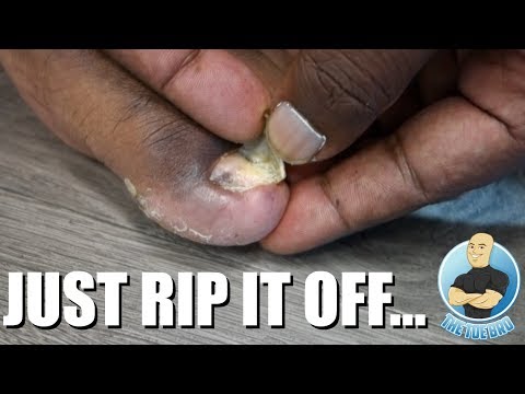 REMOVING A TOENAIL USING MY BARE HANDS!!!
