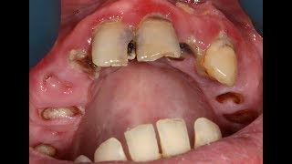 Graphic Teeth Extractions In HD Glory