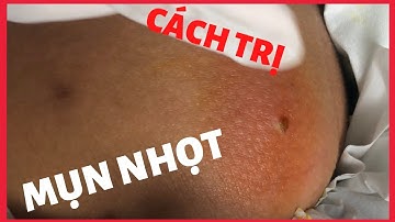 Mụn nhọt ở mông | cách nặn mụn nhọt ở mông không đau | how to squeeze painless pimples