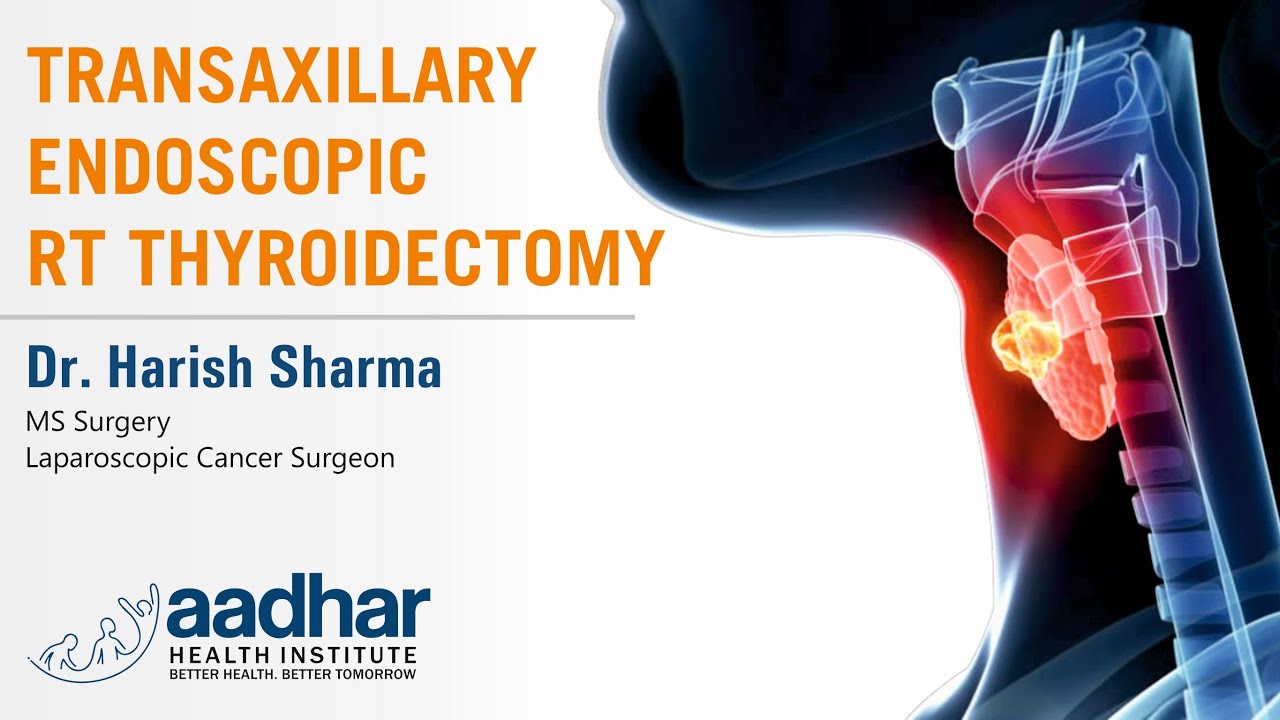 Scar Less Endoscopic Thyroidectomy Scar Less Endoscopic for Thyroid