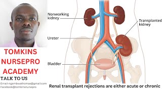 TYPES OF KIDNEY REJECTION
