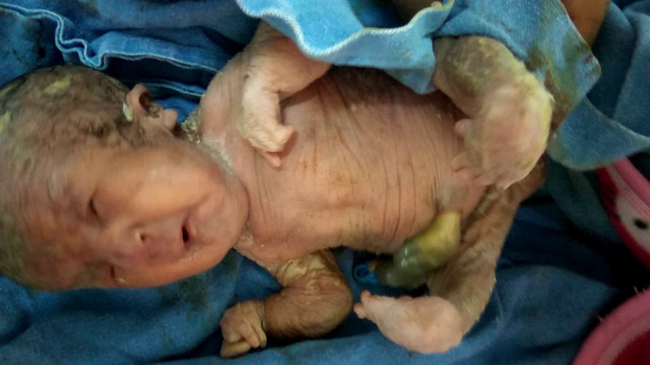 Club foot in newborn,Nepal - YouTube