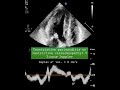 Constrictive pericarditis or restrictive cardiomyopathy? 5 Tissue Doppler 2 #echocardiography
