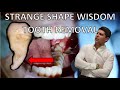 Lower partially erupted wisdom tooth removal full procedure of extraction and explanation