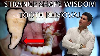 LOWER PARTIALLY ERUPTED WISDOM TOOTH REMOVAL (Full procedure of extraction and explanation) by Dr Paul's Dental World 61,126 views 4 years ago 11 minutes, 41 seconds