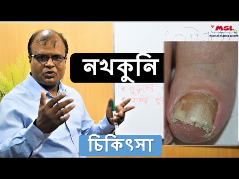 ভিডিও: নখের ছত্রাক প্রতিরোধের W টি উপায়