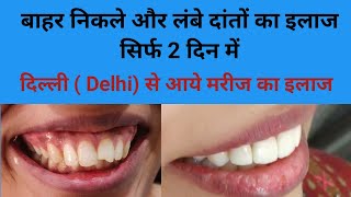 दिल्ली (Delhi)से आये मरीज़ों के बाहर निकले दांतों का इलाज सिर्फ 2 दिन में//लंबे दांतों का इलाज Smile