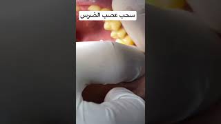 سحب عصب الضرس dentistry dentist teeth teethcleaning doctor أسنان