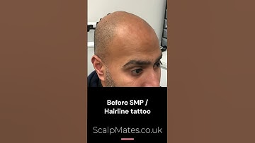 Revitalized Hairline 1 Year After 3 Sessions #SMP Transformation #scalpmicropigmentation #shorts