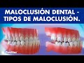 Maloclusión - Tipos de maloclusiones dentales ©