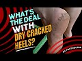 Dry Cracked Heels: From The DMs, Episode 3