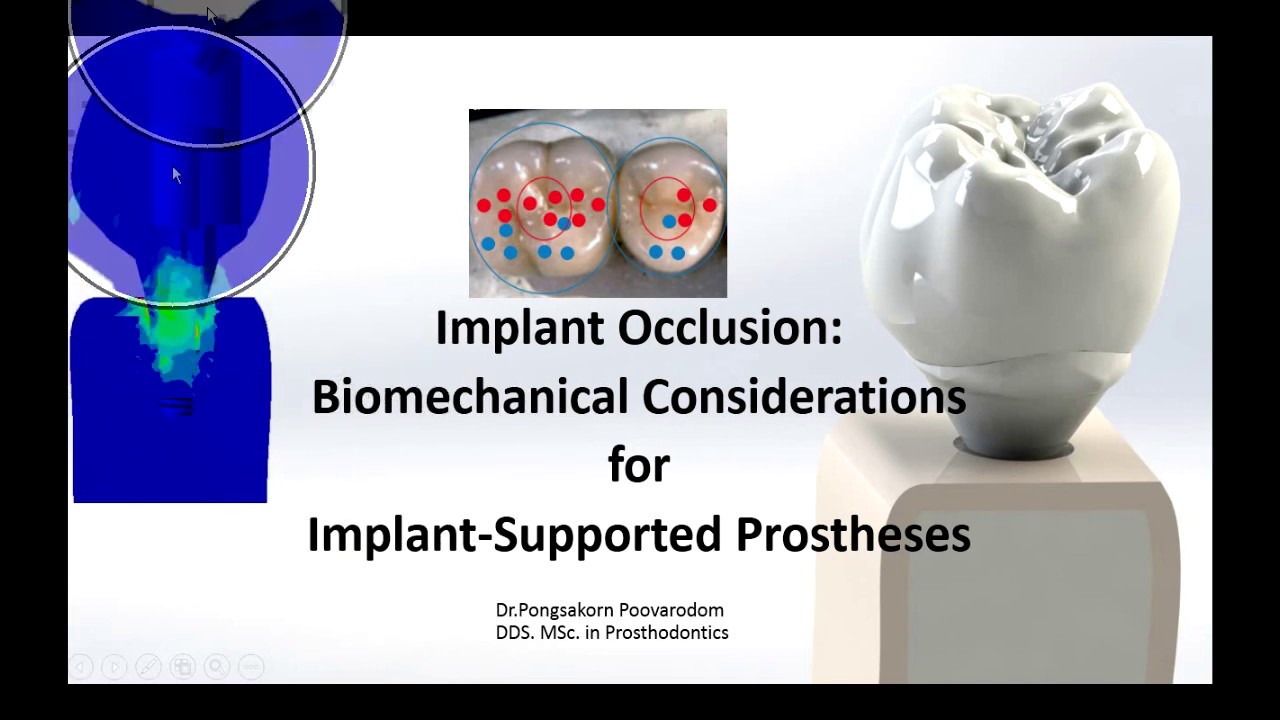 Restorative Procedure Single Crown part III
