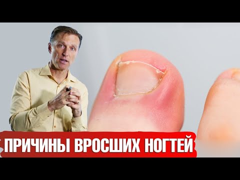 Вросший ноготь на ноге: причины👣