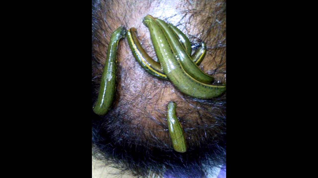 Leech Therapy For Hair FallBaldnessExemaPsoriasisDandruff