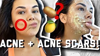GET RID OF ACNE + ACNE SCARS AT HOME