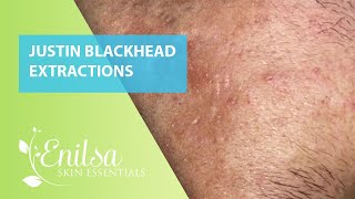 Blackheads Extractions Justin 1st Treatment