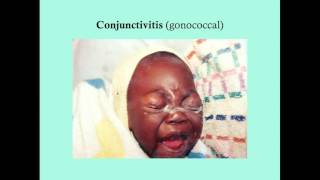 Conjunctivitis - CRASH! Medical Review Series