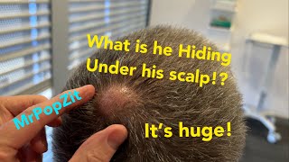 Very large 20 year old scalp bump completely removed. Must see Bumpy lobulated sac.