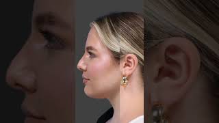 Results After FaceTite